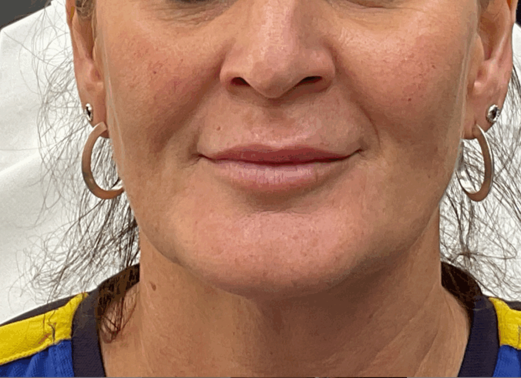 Microneedling Near Me