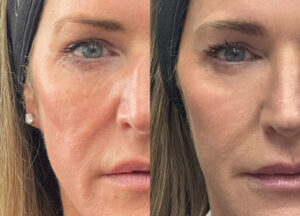 collagen stimulating treatments